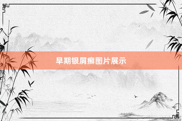 早期银屑癣图片展示
